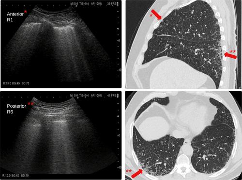 Detection of Interstitial Lung Disease in Rheumatoid Arthritis by Thoracic Ultrasound: A Diagnostic Test Accuracy Study