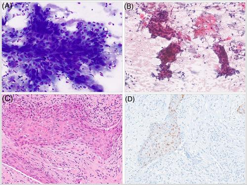 A case of fine-needle aspiration of a neck mass with atypical squamous cells and macrophages