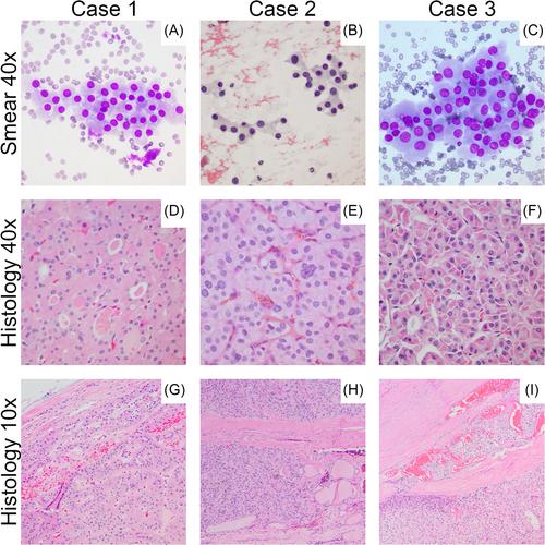 A case series of thyroid fine needle aspiration biopsies diagnosed as follicular neoplasm with oncocytic features