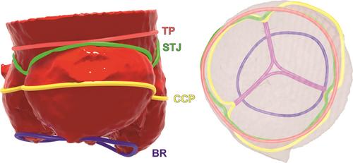 Aortic root morphometry revisited—Clinical implications for aortic valve interventions