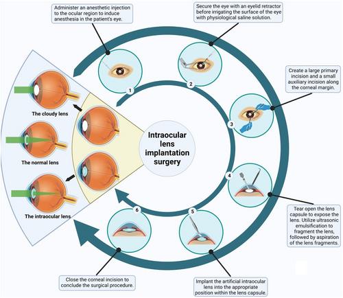 Eye of the future: Unlocking the potential utilization of hydrogels in intraocular lenses