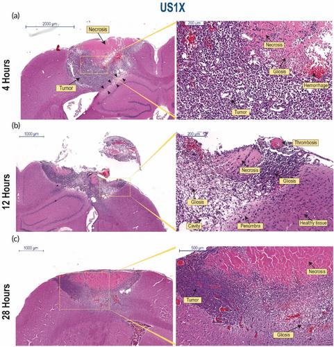 Ultrasound inhibits tumor growth and selectively eliminates malignant brain tumor in vivo