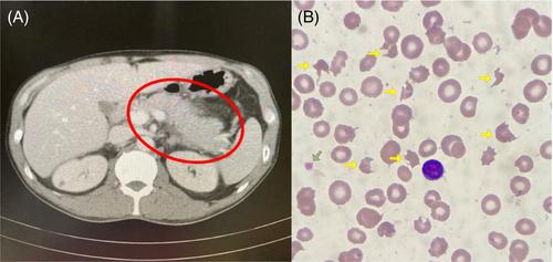 A rare manifestation presenting as acute pancreatitis of thrombotic thrombocytopenic purpura