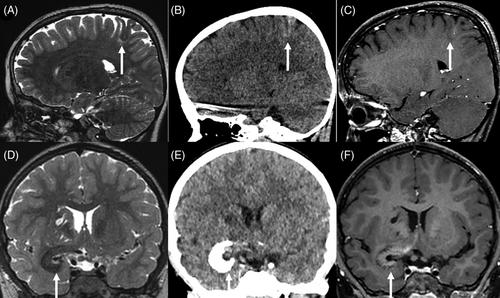 A comprehensive histomolecular characterization of meningioangiomatosis: Further evidence for a precursor neoplastic lesion