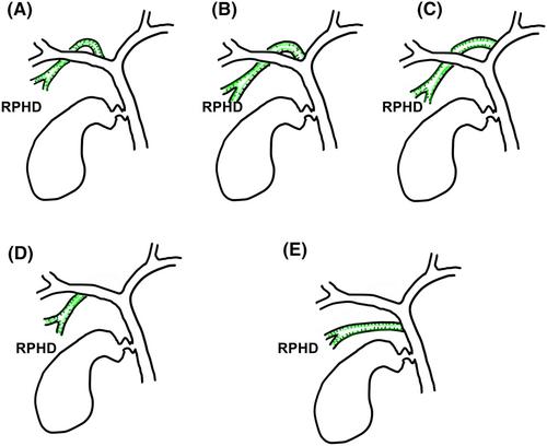 Relationship between postoperative biliary complications and biliary anatomical aspects in performing right anterior- or central bisectionectomy: Single-center retrospective observational study