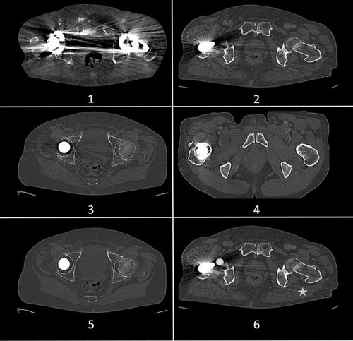 Photon-counting detector computed tomography for metal artifact reduction: a comparative study of different artifact reduction techniques in patients with orthopedic implants