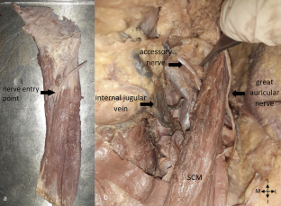 Intramuscular nerve distribution of the sternocleidomastoid muscle for the botulinum toxin injection