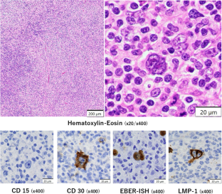 Lymphoid Proliferations and Lymphoma Associated with Immune Deficiency, and Dysregulation in a Patient Treated with Cyclosporine Monotherapy for Psoriasis