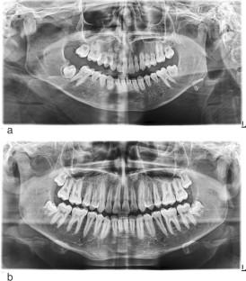 Temporomandibular Joint and Dental Complications in Long-Term Survivors of Children with Leukemia after Chemoradiotherapy and Stem Cell Transplantation