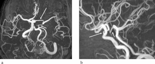 Combined lie’s type D and type a agenesis of the left internal carotid artery diagnosed by magnetic resonance angiography