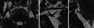 Medikamentöse Therapie der Trigeminusneuralgie