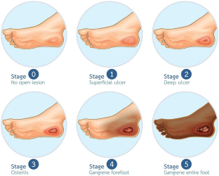 DFootNet: A Domain Adaptive Classification Framework for Diabetic Foot Ulcers Using Dense Neural Network Architecture