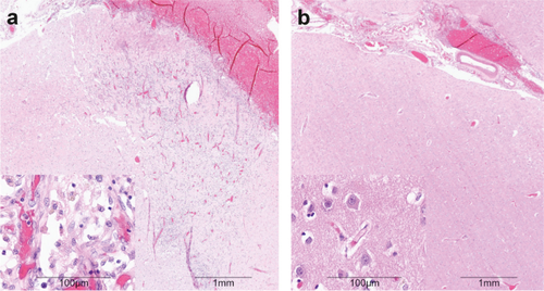 All Three Supersystems—Nervous, Vascular, and Immune—Contribute to the Cortical Infarcts After Subarachnoid Hemorrhage