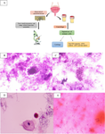 Application of PLK1 and HOXA13 Gene Expression Levels in Urine in the Diagnosis of Non-muscle Invasive Bladder Cancer.