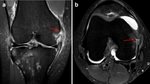 High prevalence of associated injuries in anterior cruciate ligament tears: A detailed magnetic resonance imaging analysis of 254 patients.