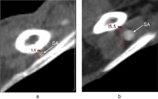 Endoscopically assisted transaxillary release of the scalene muscles for thoracic outlet syndromes: a comparison with or without first rib resection.