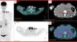 Challenges and pitfalls in the management of endocrine toxicities from immune checkpoint inhibitors: a case presentation of synchronous thyrotoxicosis and primary adrenal insufficiency in a melanoma patient.