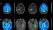 How to evaluate perfusion imaging in post-treatment glioma: a comparison of three different analysis methods.