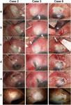 A novel bleb revision technique: lining with tenon's patch graft for treatment of large, ischemic, leaking blebs with severe conjunctival scarring after trabeculectomy.