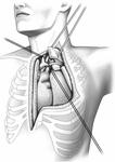 Surgical resection of advanced intrathoracic tumors through a combination of the hemiclamshell and transmanubrial approaches.