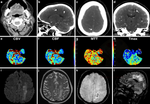 Severe Complications After Ozone Therapy-related Stroke : A Case Report.