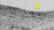 Transmission electron microscopic study of the surface layer of surgical resected disc specimens in human temporomandibular joint