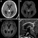 A case of a pineal parenchymal tumor of intermediate differentiation with bifocal lesions differentiated by negative placental alkaline phosphatase in the spinal fluid.