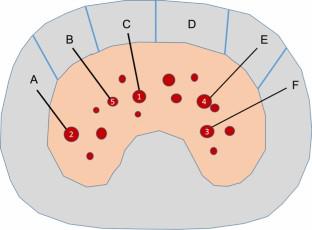 Performance Comparison of Augmented Reality Versus Ultrasound Guidance for Puncture: A Phantom Study.