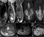 Massive spinal epidural infantile hemangioma, image findings, and treatment: a case report and review of literature.