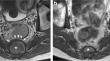 Sacrococcygeal chordoma with spontaneous regression due to a large hemorrhagic component.