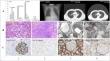 Tubulointerstitial injury and renal outcome after minimum lethal dose of diquat intoxication.