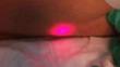 Petit's Lumbar Triangle Transillumination at Colonoscopy: The Red Light Brake Sign.