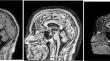 Early detection of Alzheimer’s disease using squeeze and excitation network with local binary pattern descriptor