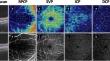 Assessment of OCT-Based Macular Curvature and Its Relationship with Macular Microvasculature in Children with Anisomyopia.