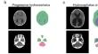 Intracranial volumetric evaluation in postnatally repaired myelomeningocele infants.