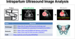 PSFHSP-Net: an efficient lightweight network for identifying pubic symphysis-fetal head standard plane from intrapartum ultrasound images.