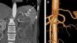 Aneurysms of splenic artery in a patient with autosomal dominant polycystic kidney disease.