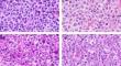 Identification of CD5/SOX11 double-negative pleomorphic mantle cell lymphoma.