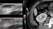 Ultrasound and CT findings of subcutaneous metastases in trunk and pelvis: a comprehensive analysis.