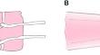 Biomechanical and histological comparison of two suture configurations for soft tissue grafts: speedtrap™ versus krackow stitch.