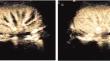 Application of ultrasound in early prediction of delayed graft function after renal transplantation.