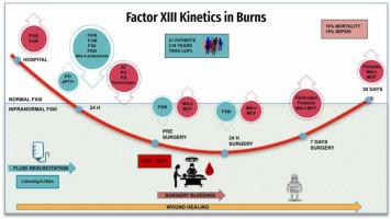 Factor XIII in major burns coagulation