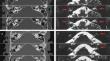 Cochlear implantation for rare Streptococcus suis meningitis with hearing loss.