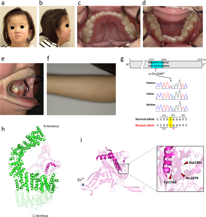 Characteristic craniofacial defects associated with a novel USP9X truncation mutation.