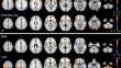 The Role of Cerebellum and Basal Ganglia Functional Connectivity in Altered Voluntary Movement Execution in Essential Tremor.