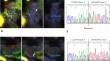 Early gastric cancer with RhoGAP fusion is linked to frequent nodal metastasis and a part of microtubular-mucocellular histology.