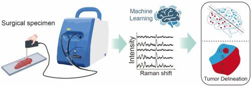 Raman spectroscopy for esophageal tumor diagnosis and delineation using machine learning and the portable Raman spectrometer.