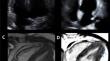 The Role of Multimodality Imaging in Cardiomyopathy.