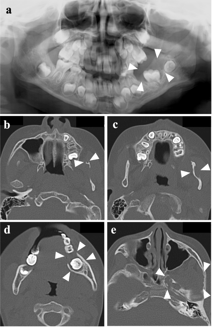 NF1 with 47,XYY mosaicism diagnosed by mandibular neurofibromas