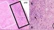 Radiological insights into rheumatoid meningitis - a rare central nervous system manifestation of rheumatoid arthritis: a retrospective review of six cases.